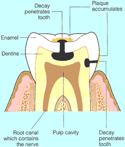 Bệnh sâu răng: nguyên nhân và cách phòng bệnh