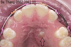 Một số dạng điển hình của việc răng mọc không thẩm mỹ ở trẻ mới lớn và lựa chọn nắn chỉnh