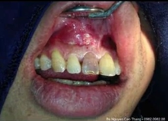 Phẫu thuật nang chân răng do hậu quả chấn thương gây chết tủy răng